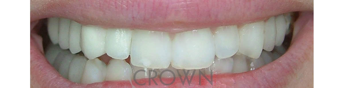 Crown Dental Labor