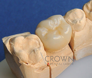 Crown Dental Labor