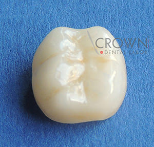 Crown Dental Labor