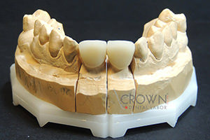 Crown Dental Labor