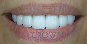 Crown Dental Labor