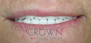 Crown Dental Labor