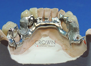 Crown Dental Labor