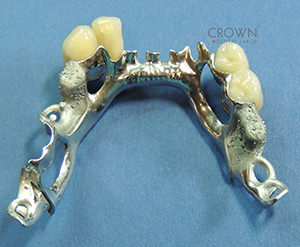 Crown Dental Labor