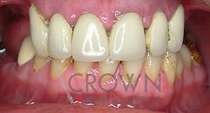 Crown Dental Labor