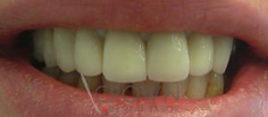 Crown Dental Labor