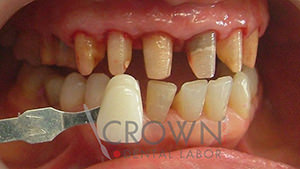 Crown Dental Labor