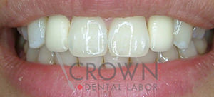 Crown Dental Labor