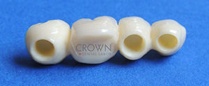 Crown Dental Labor