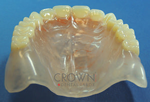 Crown Dental Labor