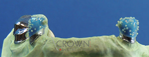 Crown Dental Labor