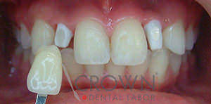 Crown Dental Labor