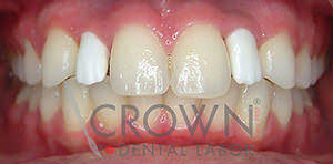 Crown Dental Labor