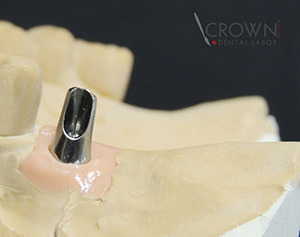 Crown Dental Labor