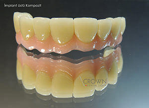 Crown Dental Labor