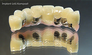 Crown Dental Labor