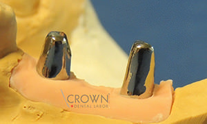 Crown Dental Labor