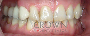 Crown Dental Labor