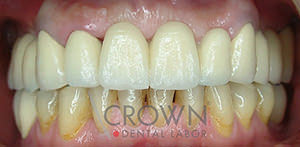 Crown Dental Labor