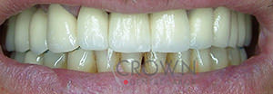 Crown Dental Labor