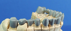 Crown Dental Labor