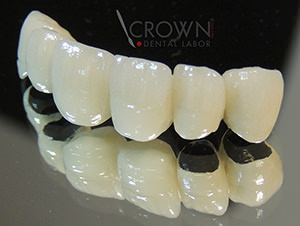 Crown Dental Labor