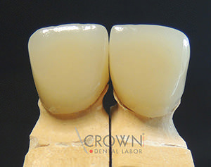 Crown Dental Labor