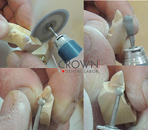 Crown Dental Labor