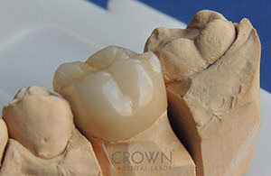 Crown Dental Labor