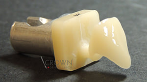 Crown Dental Labor