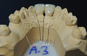 Crown Dental Labor