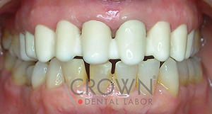 Crown Dental Labor