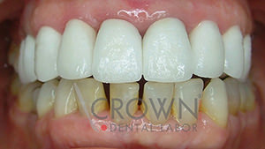 Crown Dental Labor