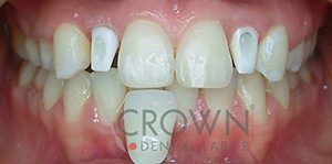 Crown Dental Labor