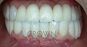 Crown Dental Labor