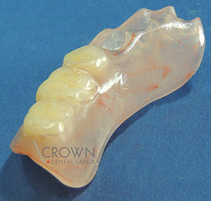 Crown Dental Labor