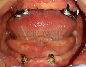 Crown Dental Labor