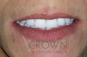 Crown Dental Labor