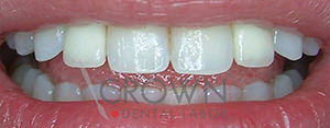 Crown Dental Labor