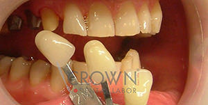 Crown Dental Labor