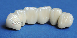 Crown Dental Labor