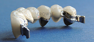 Crown Dental Labor