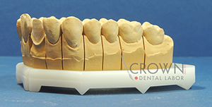 Crown Dental Labor